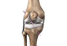 ACL Reconstruction