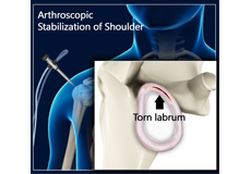 Arthroscopic Shoulder Stabilisation