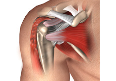 Biceps Tenotomy and Tenodesis
