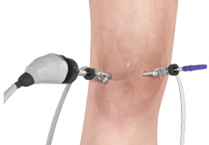 Knee Arthroscopy