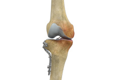 Knee Osteotomy