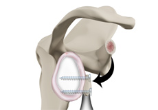 Latarjet Procedure