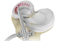 Meniscal Surgery