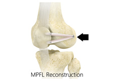 MPFL Reconstruction