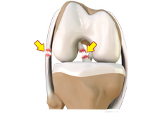 Multiligament Reconstruction