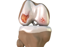 Osteoarthritis Management