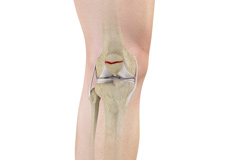 Patellar Fracture