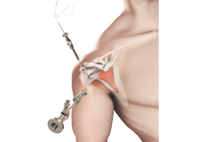 Shoulder Arthroscopy