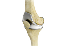 Total Knee Replacement